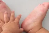 Ca mắc tay chân miệng tăng, chuyên gia khuyến cáo '3 sạch' để phòng bệnh