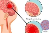 Bệnh não mô cầu có thể gây tử vong nhanh, chuyên gia cảnh báo những dấu hiệu nguy hiểm