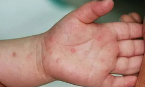 Nhiều ca nặng bệnh tay chân miệng, Bộ Y tế yêu cầu khẩn trương phòng bệnh