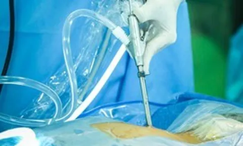 Bệnh lý cột sống: Bước tiến khoa học từ các kỹ thuật ít xâm lấn thế hệ mới