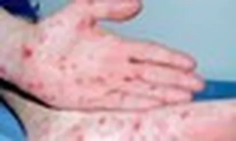TPHCM: Số người mắc bệnh giang mai tăng đột biến