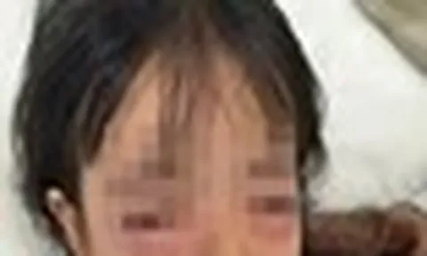 Bé gái 5 tuổi nhập viện, mắt sưng vù sau khi chơi bong bóng xà phòng