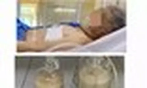 Hút ra hàng lít mủ từ phổi người đàn ông ở Đà Nẵng