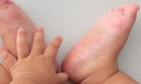 Ca mắc tay chân miệng tăng, chuyên gia khuyến cáo '3 sạch' để phòng bệnh