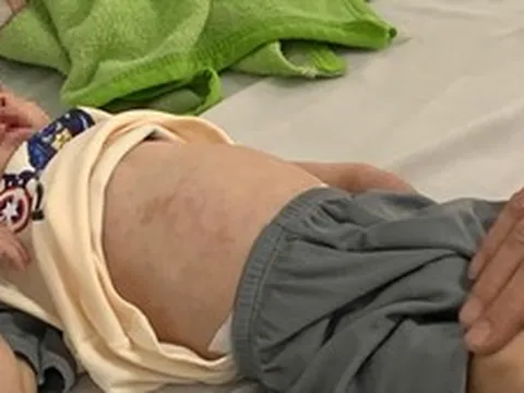 Số ca sốt xuất huyết và tay chân miệng tăng nhiều lần