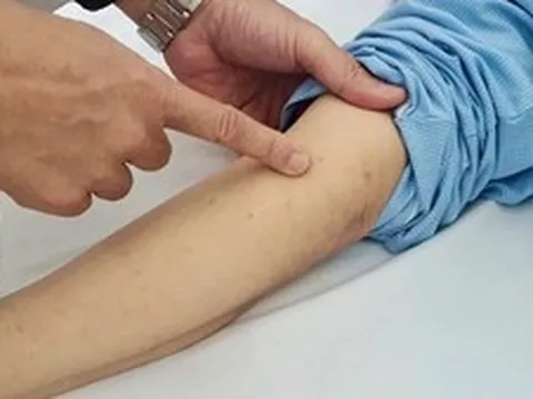 Phú Quốc ghi nhận ca nghi viêm màng não mô cầu, ngành y tế tăng cường giám sát và phòng ngừa