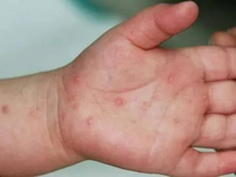 Nhiều ca nặng bệnh tay chân miệng, Bộ Y tế yêu cầu khẩn trương phòng bệnh