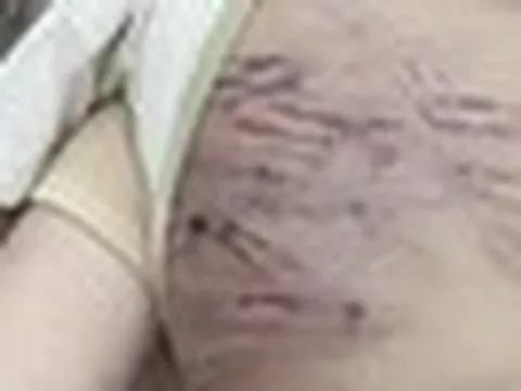 Bé trai 2 tuổi bị mẹ và người tình bạo hành đã qua cơn nguy kịch nhưng tiên lượng vẫn dè dặt