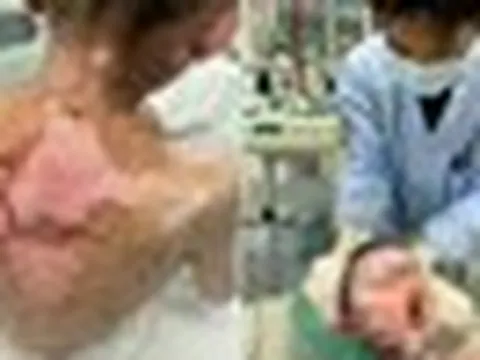Bé trai 9 tuổi bong tróc da, loét khắp cơ thể, vảy dính kín mắt miệng, nguyên nhân từ 1 loại thuốc thông dụng trong mọi gia đình