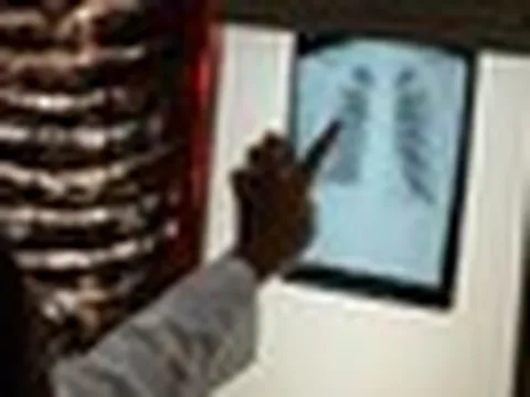 Căn bệnh ở Việt Nam 'đứng top' thế giới: Âm thầm gia tăng do nhiều người trẻ chủ quan